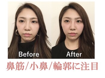 ラプリシュシュ 岡山店(Raplit)/隆鼻+輪郭矯正40分10回