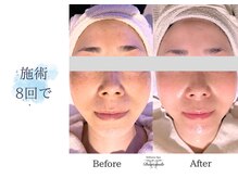 ディアスマイル(Dear.smile)/施術8回で