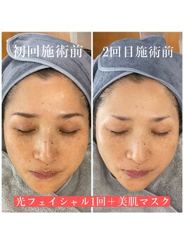 サロンピュア 所沢店/光フェイシャル施術前を比較♪