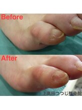 上高田つつじ整体院/フットケア　副爪ケア　施術例