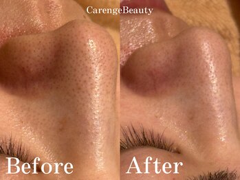 カレンジェビューティー(CarengeBeauty)/ハイドラ水光ピーリング