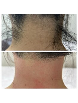 はだころも/うなじ wax脱毛