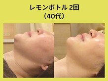 アユアランリンク 錦糸町店/レモンボトル2回