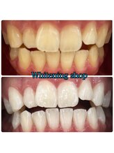 ホワイトニングショップ 大阪玉造店/Before&After美白ホワイトニング