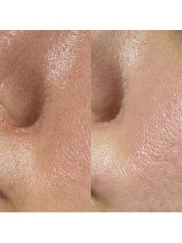 アマト 心斎橋店(Amato)/心斎橋/毛穴洗浄/ワックス脱毛