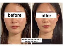 グリーン鍼灸整体院(green鍼灸整体院)/美容鍼