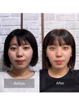 シャルム(CHARMEB)/顎をシャープに魅せる美容鍼