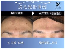メンズビービー 福井高柳店(MEN'S BB)/眉毛脱毛施術事例