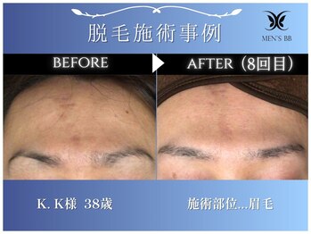 メンズビービー 福井高柳店(MEN'S BB)/眉毛脱毛施術事例