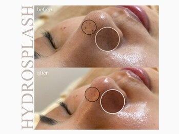 ルーナ(Runa)/■毛穴水素洗浄 初回60分¥4950