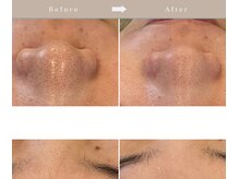 アンク(Ankh)/今、選ばれている毛穴エステ◎