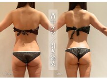 シューラディアント(ShuRadiant)/背中・二の腕スッキリ！