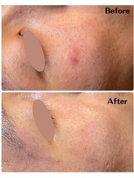 ルタンリッシュオム(Lutan Riche hom)/突然のニキビも!