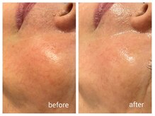 ミヌ 心斎橋(Minou)/ハーブピーリングbefore/after