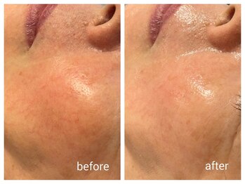 ミヌ 心斎橋(Minou)/ハーブピーリングbefore/after