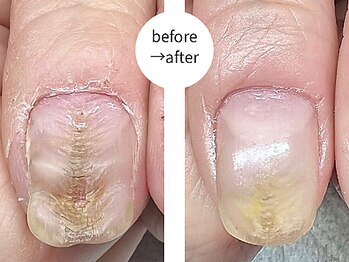 エマ(EMA)/凸凹爪でお悩みの方の自爪育成