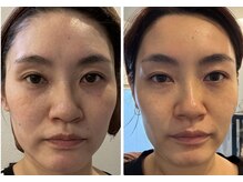 オレアグリーン 岡崎(OLEA green)/ハーブピーリング+ホームケア