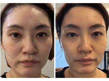 オレアグリーン 岡崎(OLEA green)/ハーブピーリング+ホームケア