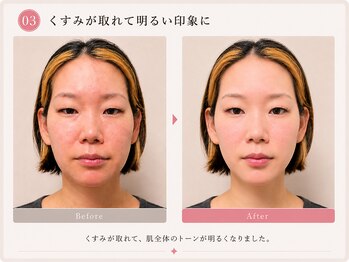 モアフェイス 池袋店(More Face)/小顔矯正・肌ツヤ・リンパ