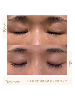 ルソール(Le seul)の写真/【インディバ×ヒト幹細胞】成長因子を含むヒト幹細胞培養上清液で夏ダメージに負けない肌づくりを