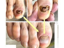 自爪ケアサロン 横浜/爪のトラブル相談 手or足