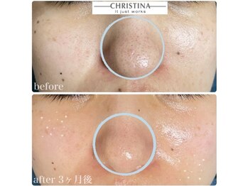 ちらちゅら/クリスティーナ【施術経過】