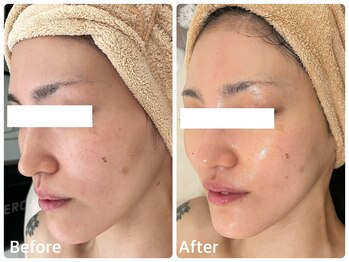 ナビ(NABI)/肌質改善!エクソソーム導入