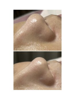 ビューティービューティー(beauty×beauty)/毛穴洗浄