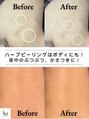 ベル 新潟(Belle)&nbsp;夏前！背中 ニキビケア