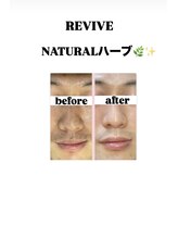 ナルフロウ(nalufurou)/剥離なし国産ハーブピーリング