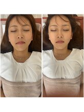 鍼灸サロン ヒマワリ(himawari)/美容鍼 左before 右after