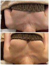 ラディス(Radice.)/【バストアップ症例】☆