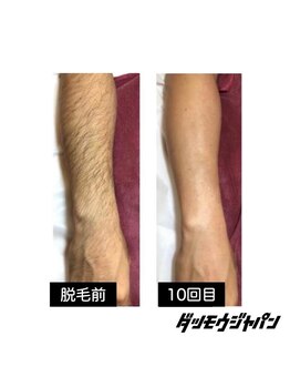 ジャパン 東広島店(JAPAN)/【腕脱毛 Before → After】