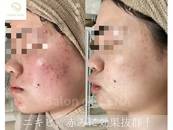 サロンドレナ 名駅店/ハーブピーリング サロンドレナ