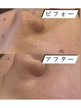 レイ エステティック 江南店(RAY ESTHETIC)/毛穴洗浄×顔脱毛