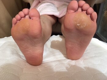 ビサンテ サロン/たこ,ガサガサ足裏に角質ケア-1