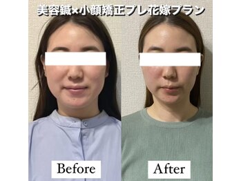 ハリカ 大阪心斎橋店(HARIKA)/歯ぎしり食いしばり癖に美容鍼