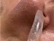 ロンロン(RON-RON)の写真/【韓国式3D毛穴洗浄】最新美容・今SNSで話題の韓国式3D毛穴洗浄。毛穴の黒ずみ・開きを改善♪