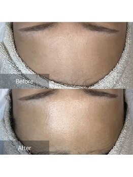 ホワイトアクア 梅田本店(WHITE AQUA)/ララピール/大阪/梅田/毛穴/小顔