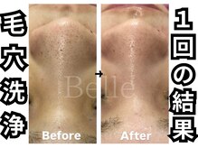 ベル 心斎橋店(Belle)/2剤で洗う毛穴洗浄