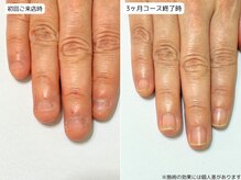 カピリナ(Ka Pilina)/自爪育成・深爪・川崎