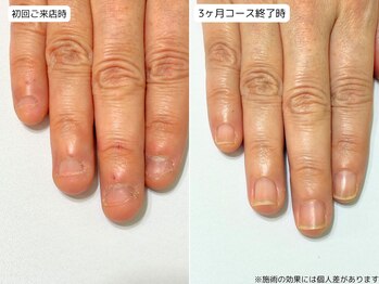 カピリナ(Ka Pilina)/自爪育成・深爪・川崎