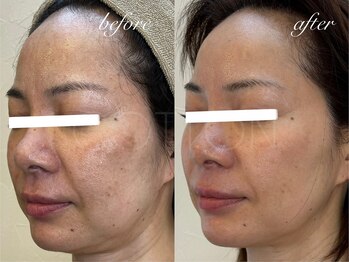 プライベートサロン コットン(COTTON)/肌改善プログラム