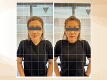 エモア メディカル整体院 恵比寿院(Emoa)/【20代女性】小顔矯正