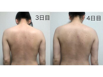 リベル 名古屋(Lebelle:)/ハーブピーリング専門名古屋