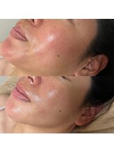 アンドミー(and me)/鹿児島/唐湊/毛穴洗浄/毛穴ケア