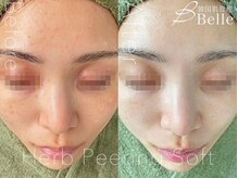 ベル 横浜(Belle)/ハーブピーリング｜ニキビケア
