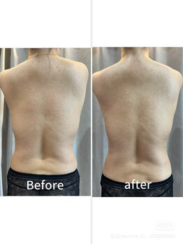 ラローゼ トウキョウ(LA ROSEE TOKYO)/最強痩身