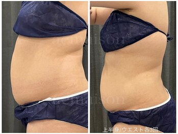 アエ メゾン(ae maison)/上半身/ウエスト各3回後