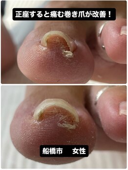 巻き爪じゅん 千葉駅前店/正座すると激痛が…お悩み改善